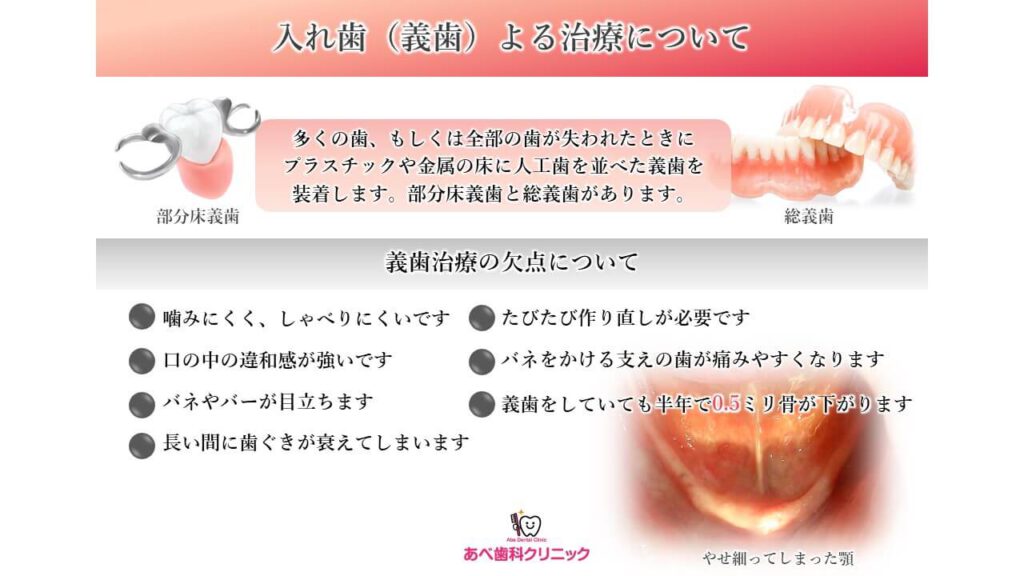 入れ歯（義歯）の治療について