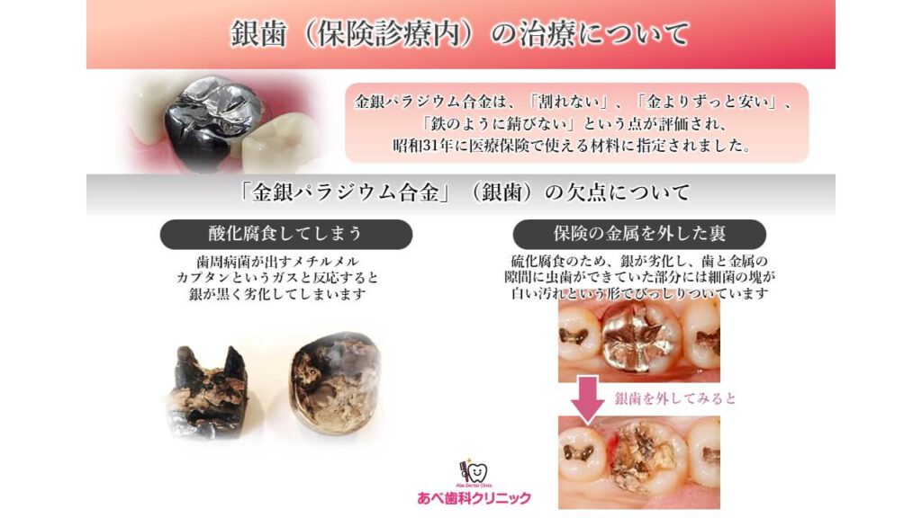 銀歯の治療について