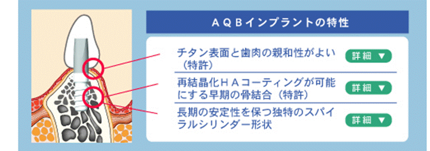 AQBインプラント