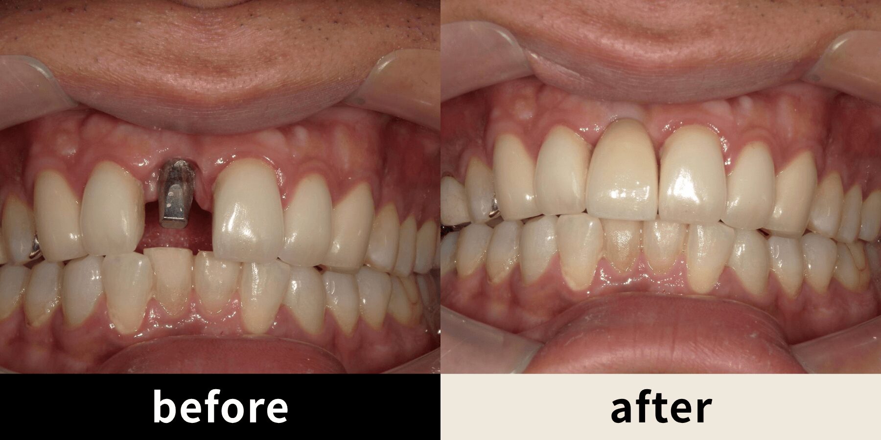 インプラント治療