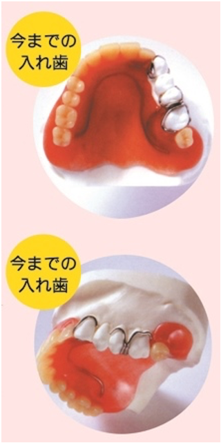 今までの入れ歯